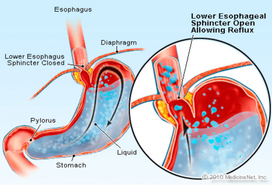 โรคกรดไหลย้อน